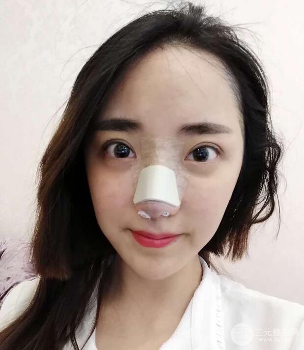 東莞寶格麗韋文奇隆鼻整形果圖分享，對比曝光