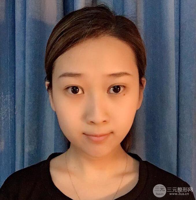 嘉和百旺蘇乾泰隆鼻整形術(shù)后三個(gè)月對(duì)比照分享