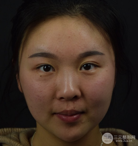 面部光纖溶脂三個月恢復(fù)記錄，妹子終于擺脫大臉盤子辣