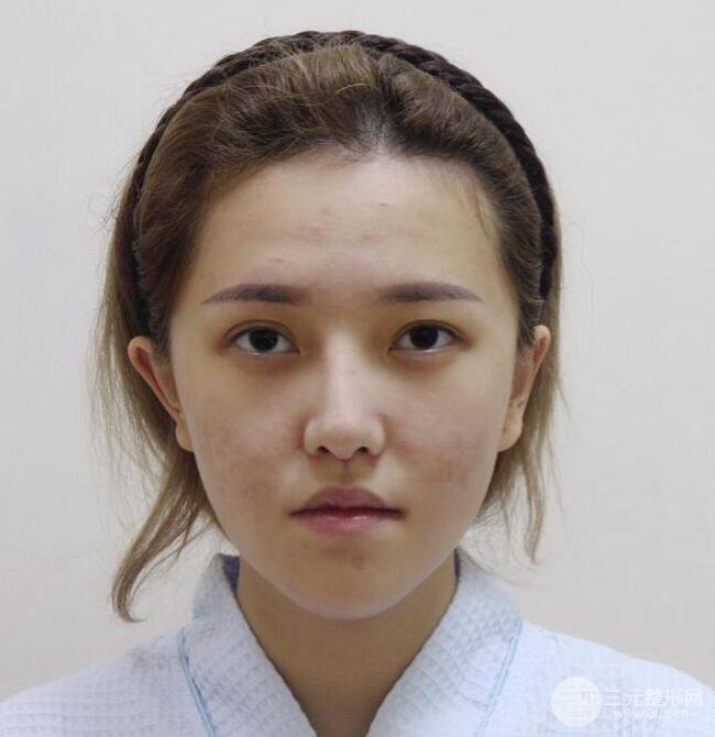 煙臺(tái)青韓醫(yī)療美容施問(wèn)國(guó)隆鼻整形對(duì)比照分享