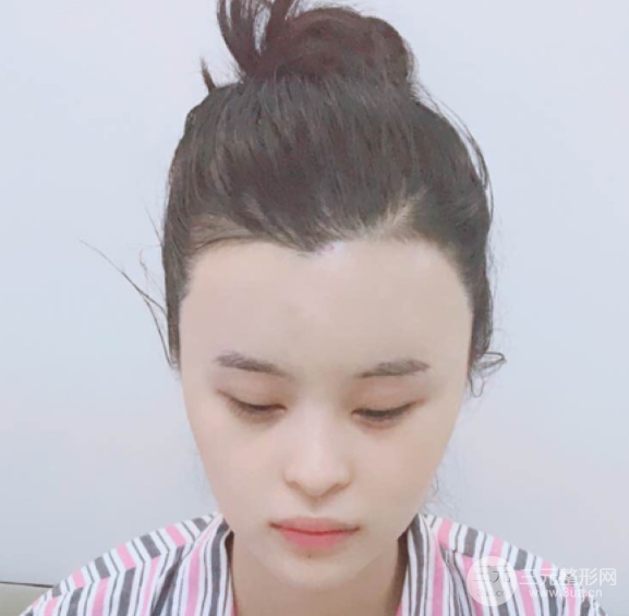 自體脂肪填充一個(gè)月真實(shí)恢復(fù)圖片，恢復(fù)后連閨蜜都驚艷辣