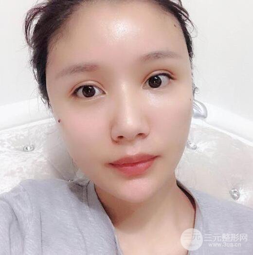 辣媽做了自體脂肪填充全臉，對比圖分享