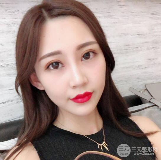 割雙眼皮兩個(gè)月是啥樣，妹子公開(kāi)恢復(fù)記錄
