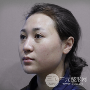 進(jìn)口假體+肋軟骨墊鼻尖三個(gè)月果恢復(fù)對(duì)比圖