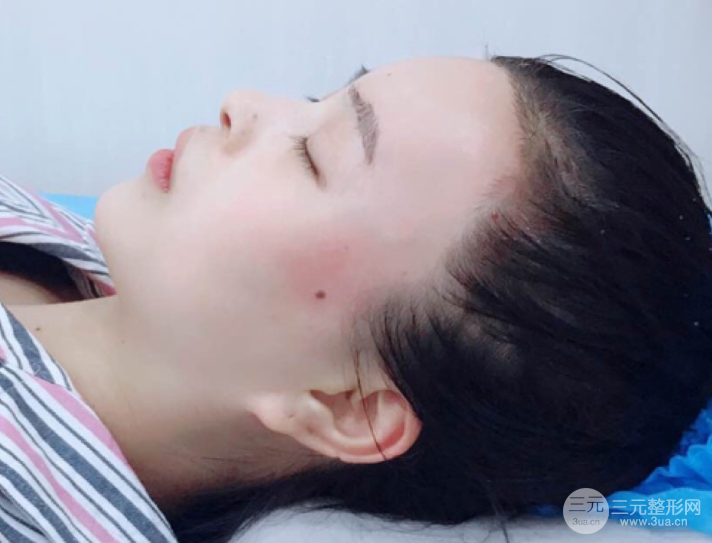 自體脂肪填充一個(gè)月真實(shí)恢復(fù)圖片，恢復(fù)后連閨蜜都驚艷辣