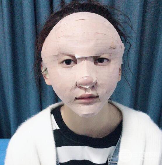 廣州名韓醫(yī)療美容卓敬錫“隆鼻整形+自體脂肪填充全臉”案例分享，整完有點像景甜