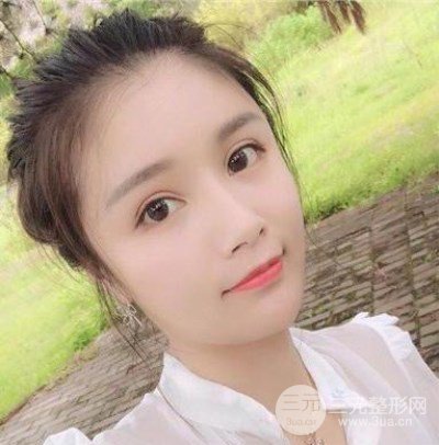 辣媽做了自體脂肪填充全臉，對比圖分享