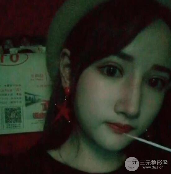去下頜角+顴骨內推手術三個月記錄，看大臉妹如何逆襲