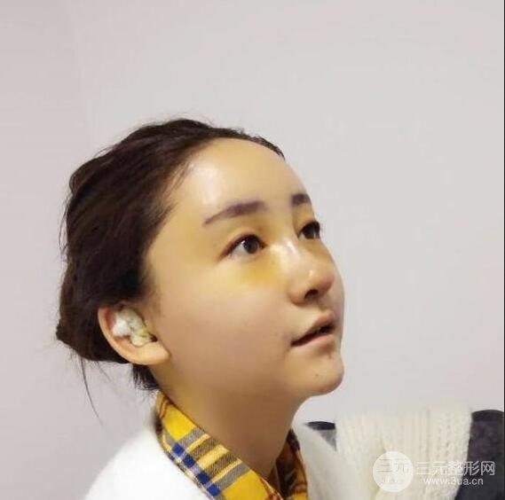 廣州名韓醫(yī)療美容卓敬錫“隆鼻整形+自體脂肪填充全臉”案例分享，整完有點像景甜
