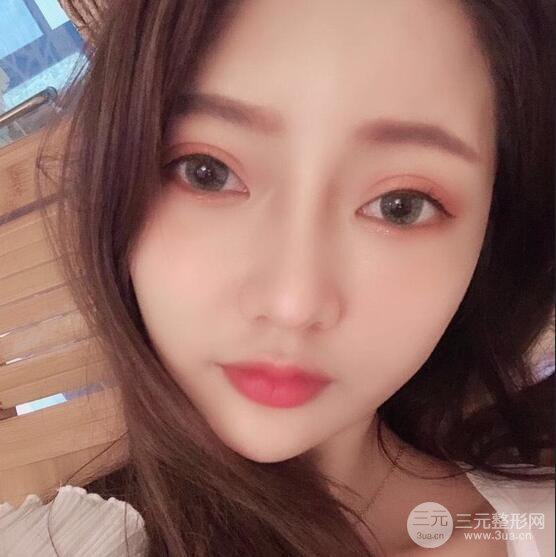 只是做了隆鼻整形改變居然辣么大，快來看看我的隆鼻整形恢復日記叭