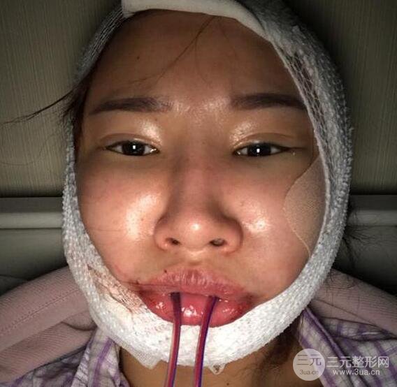 去下頜角+顴骨內推手術三個月記錄，看大臉妹如何逆襲