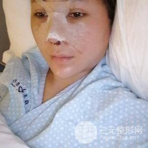 進(jìn)口假體+肋軟骨墊鼻尖三個月果恢復(fù)對比圖