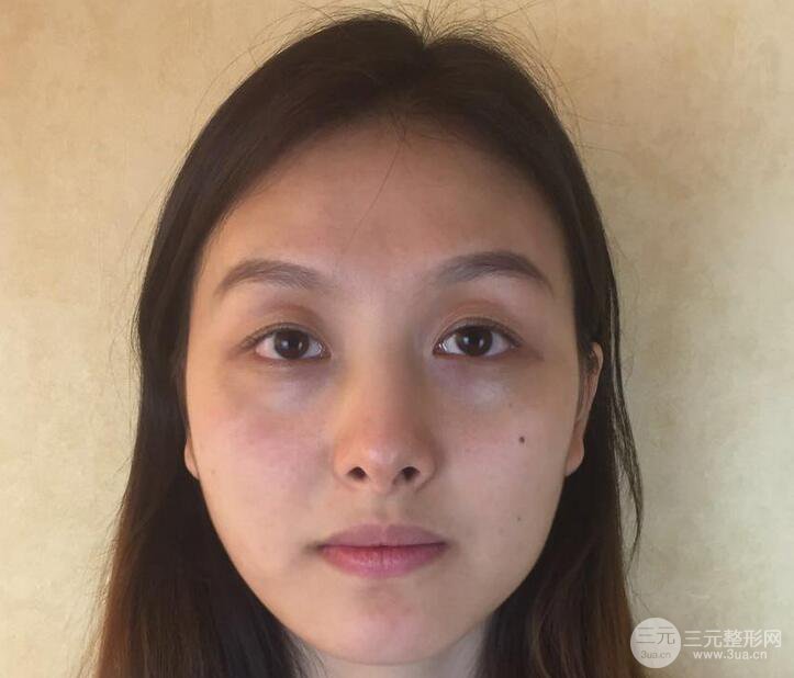 做了“埋埋蛋白線.提升+隆鼻整形”，恢復(fù)后老公說很沒有降低風(fēng)險感