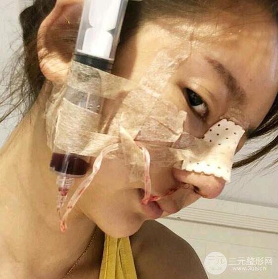只是做了隆鼻整形改變居然辣么大，快來看看我的隆鼻整形恢復日記叭