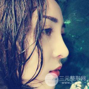 進(jìn)口假體+肋軟骨墊鼻尖三個月果恢復(fù)對比圖