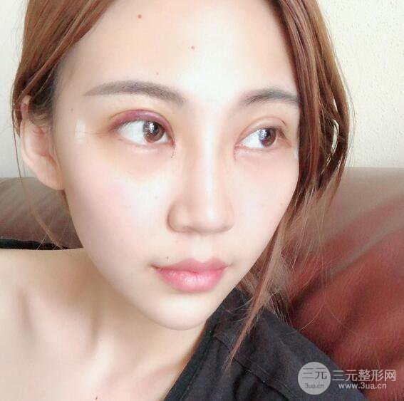 割雙眼皮兩個(gè)月是啥樣，妹子公開(kāi)恢復(fù)記錄