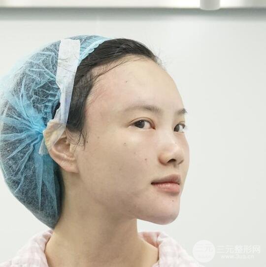 上海華美李健自體脂肪詳細(xì)部填充果圖，少女臉經(jīng)久不衰的秘密在這里