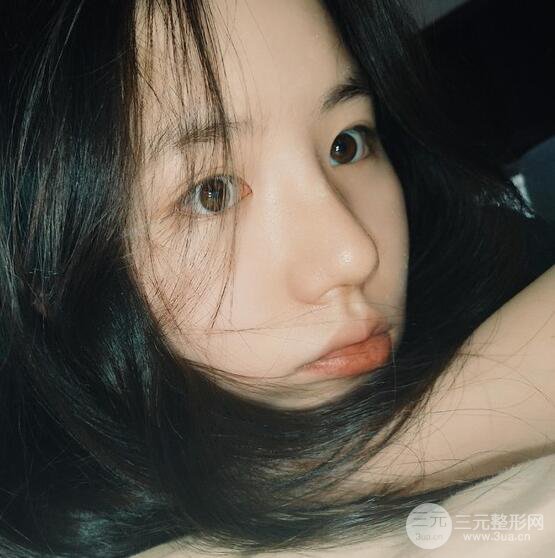 上海華美醫(yī)療美容李庭勛膨體隆鼻怎么樣？果對比圖