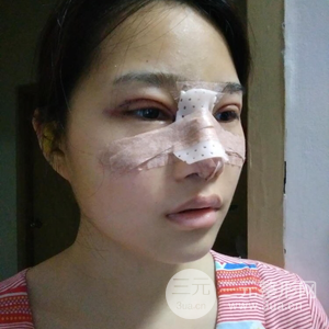 雙眼皮多項整形隆鼻整形一起做怎么樣？真人曝光果對比圖
