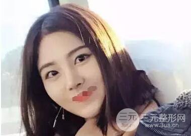 綜合隆鼻前后對比照片案例