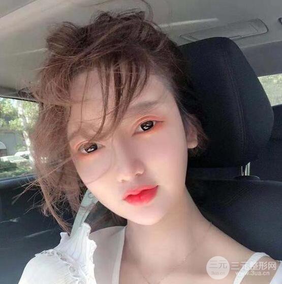 只是做了隆鼻整形改變居然辣么大，快來看看我的隆鼻整形恢復日記叭