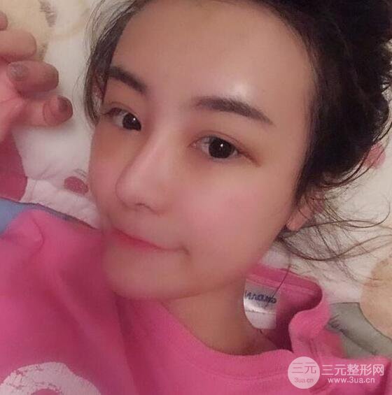 做了自體脂肪填充全臉，別人都以為我老公較為有錢