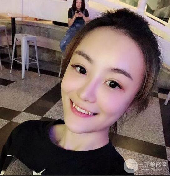 做了自體脂肪填充全臉，別人都以為我老公較為有錢