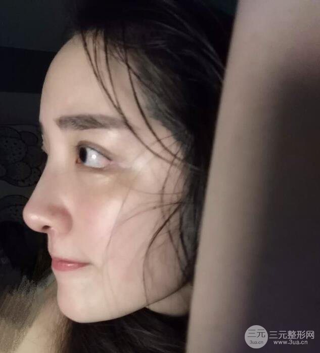 東莞寶格麗韋文奇隆鼻整形果圖分享，對比曝光