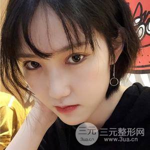雙眼皮三個(gè)月果恢復(fù)圖
