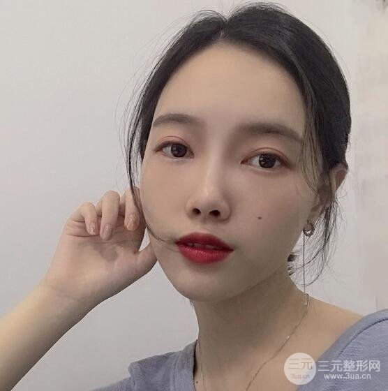 上海華美李健自體脂肪詳細(xì)部填充果圖，少女臉經(jīng)久不衰的秘密在這里