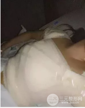 假體隆胸恢復(fù)期3個月圖片，真人日記曝光
