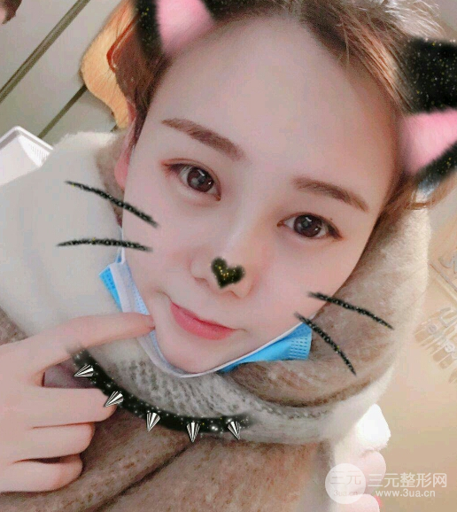 隆鼻整形三個月恢復(fù)真實(shí)圖片，做完土妹子變網(wǎng)紅辣