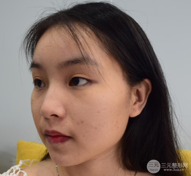 埋埋蛋白線.提升恢復(fù)圖，原來小V臉不一定要磨骨