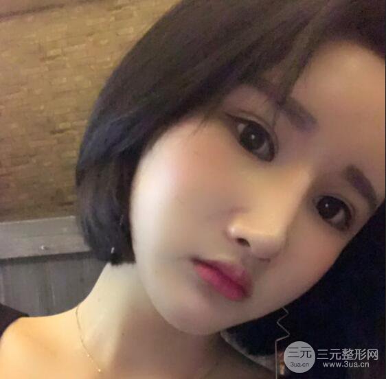 去下頜角+顴骨內推手術三個月記錄，看大臉妹如何逆襲
