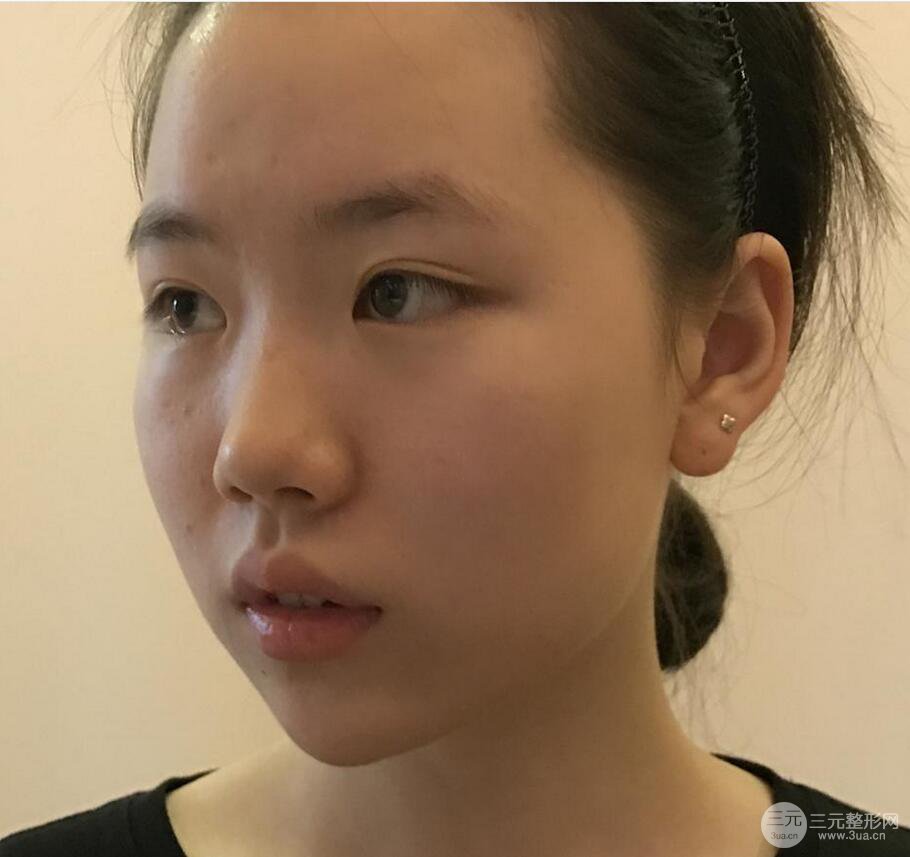 上海華美醫(yī)療美容李庭勛膨體隆鼻怎么樣？果對比圖