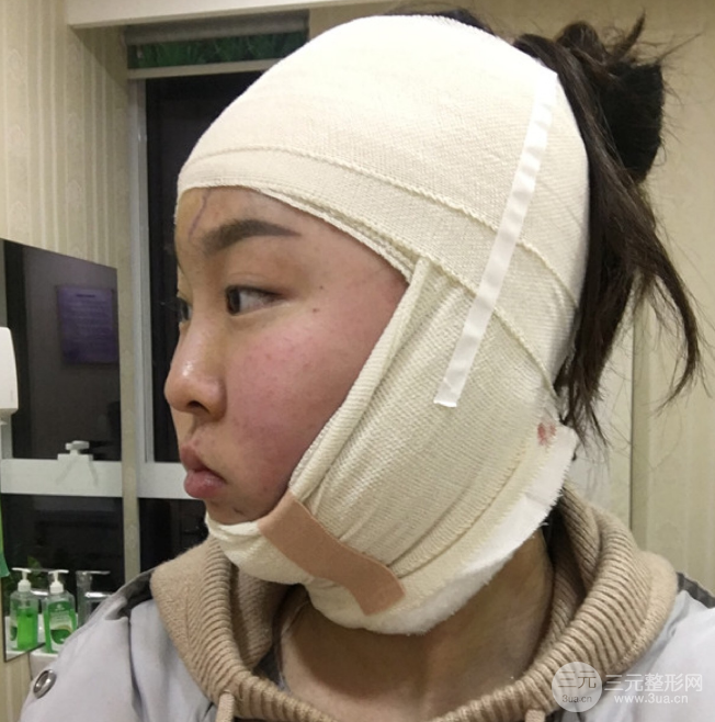 面部光纖溶脂三個月恢復(fù)記錄，妹子終于擺脫大臉盤子辣