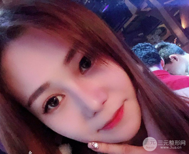 隆鼻整形三個月恢復(fù)真實(shí)圖片，做完土妹子變網(wǎng)紅辣