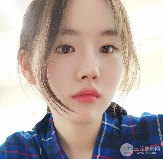 上海華美醫(yī)療美容李庭勛膨體隆鼻怎么樣？果對比圖