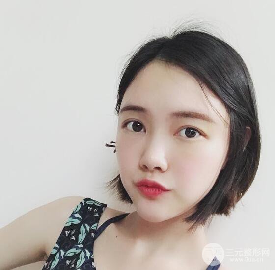 上海華美李健自體脂肪詳細(xì)部填充果圖，少女臉經(jīng)久不衰的秘密在這里