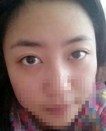 八大處靳小雷埋線雙眼皮一個(gè)多月了，果很好哦~~~
