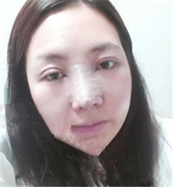 米揚麗格巫文云做的鼻部修復，恢復得不錯了