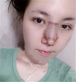 米揚麗格巫文云做的鼻部修復，恢復得不錯了