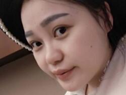 四川嬌點(diǎn)整形醫(yī)院的姜宇祿院長(zhǎng)給我做的隆鼻整形，分享給大家看看