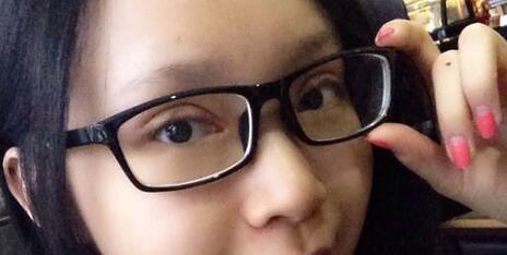 全切雙眼皮+去皮去脂+開眼角一個月了~