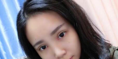 全切雙眼皮+去皮去脂+開眼角一個月了~