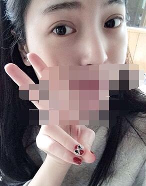 做埋線雙眼皮一周啦~果滿滿的！