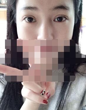 做埋線雙眼皮一周啦~果滿滿的！