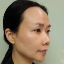 面b提升手術(shù)價格和真人案例