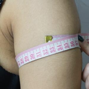 吸脂減肥瘦手臂，甩掉蝴蝶袖告別粗手臂真實(shí)案例分享