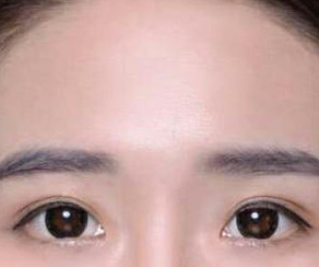 鄭東學(xué)做的雙眼皮果你來評價